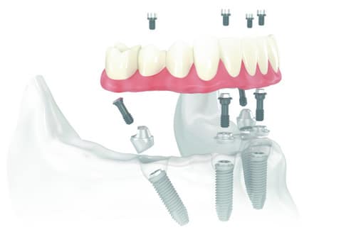 All on 4 Dental Implants Near Me - All on Four Dental Implants - Center for Dental Implants Serving Lindale - Tyler