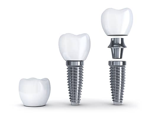 What are Dental Implants? Single, Multiple and Full Mouth Dental Implants - Center of Implant & General Dentistry Lindale - Tyler TX