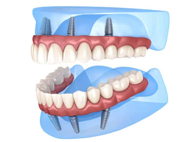 Snap on Dentures | Lindale Dentist: The Center for Implant & General