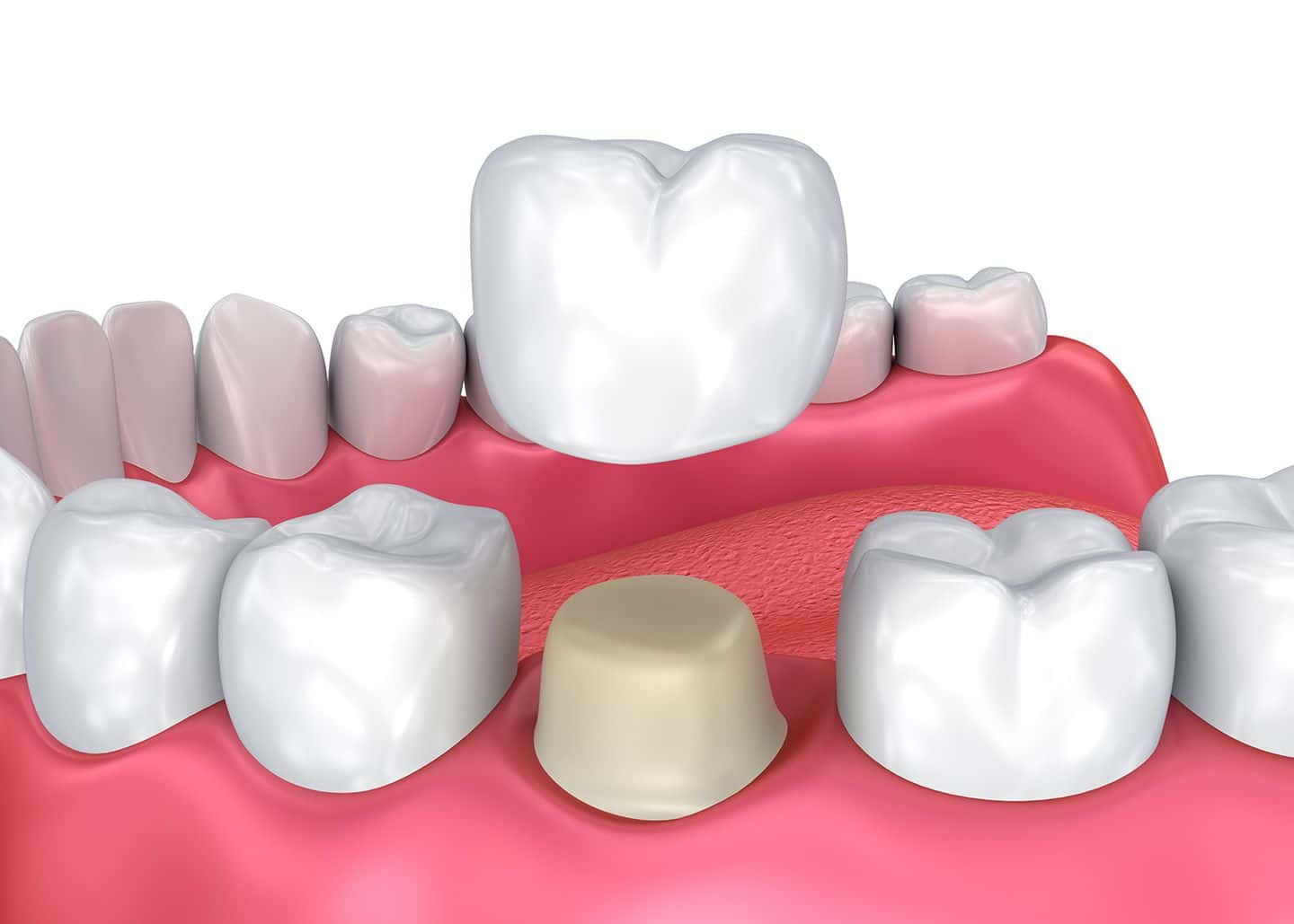 Dental-Crown-Protection-for-Weak-Tooth