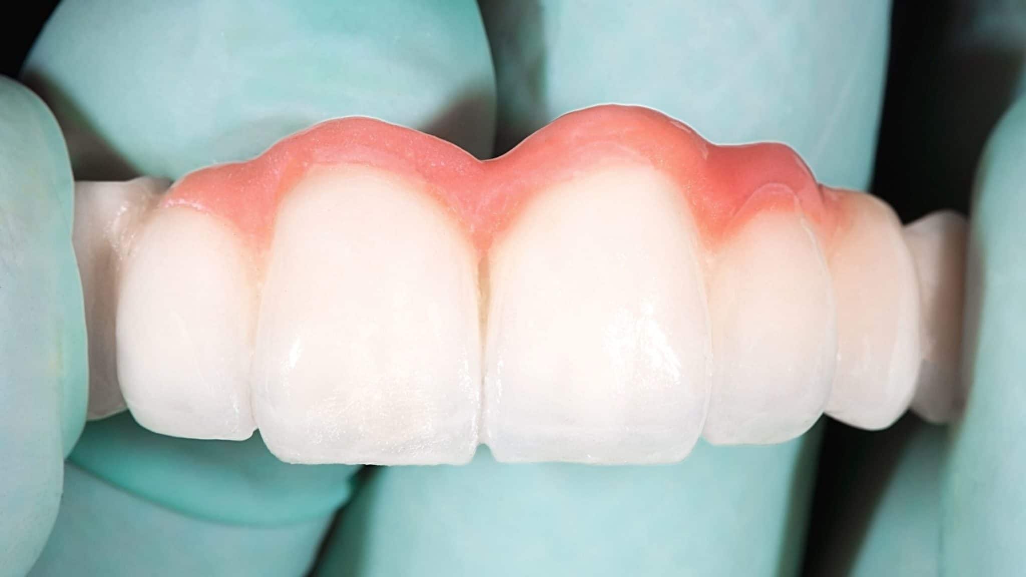What is a Dental Bridge? Lindale Dentists